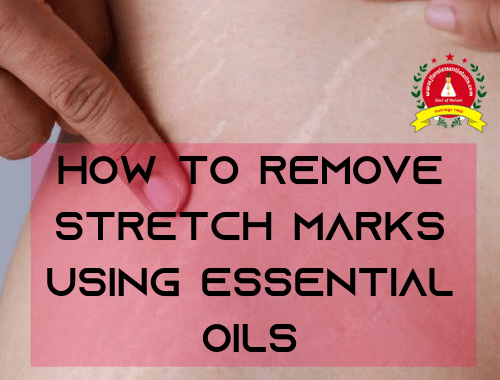 essential oils for stretch marks
